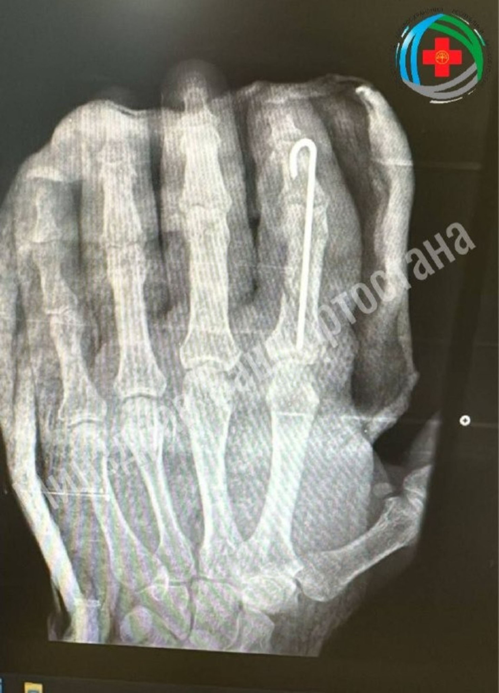 Жителю Башкирии успешно пришили отрубленный топором палец