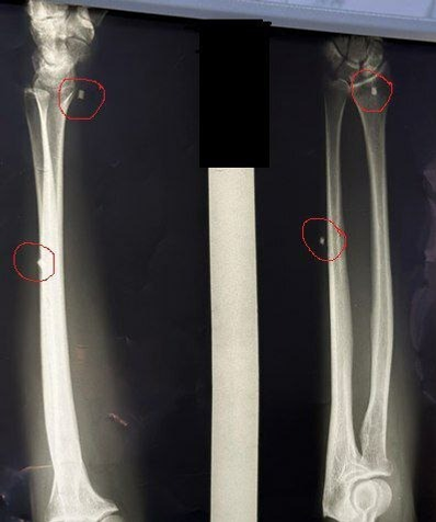 В Башкирии хирург спас руку военнослужащего СВО